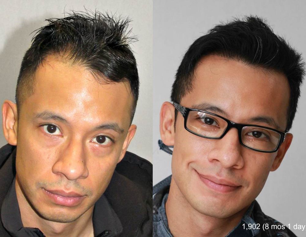Bosley patient Hector V before and after