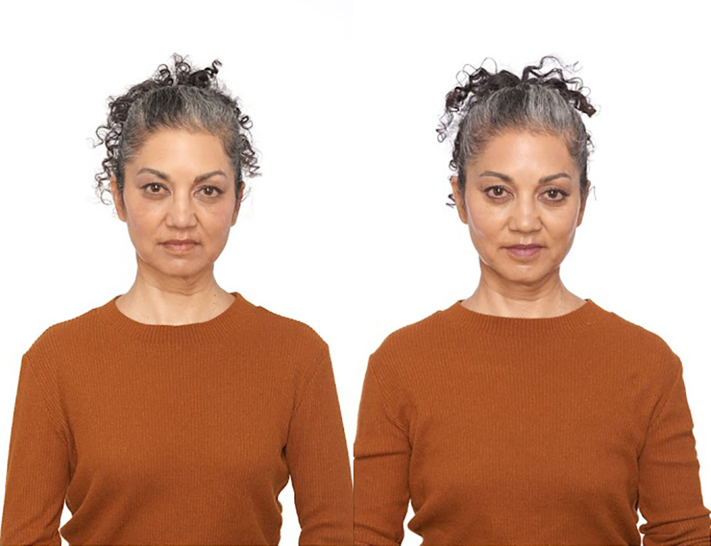 Bolsey patient Irene G before and after