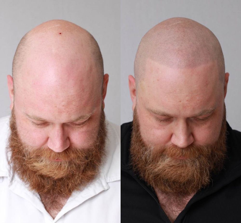 Bosley patient Isaac E before and after