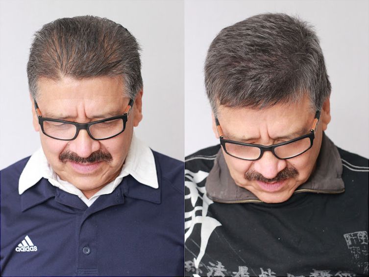 Ismael D, paciente de Bosley, antes y después