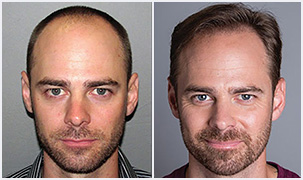 Bosley patient Jared before and after