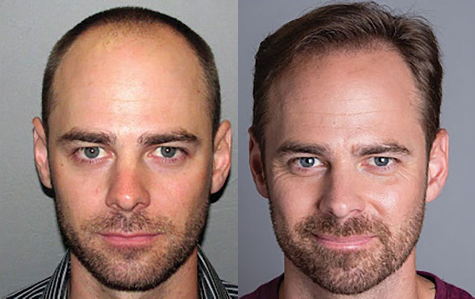 Bosley patient Jared H before and after