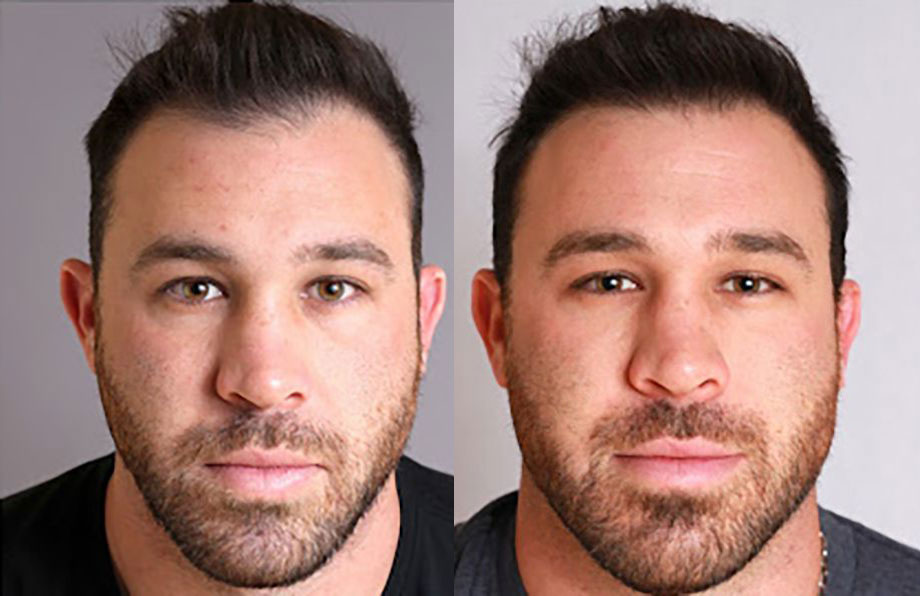 Bosley patient Jason K before and after