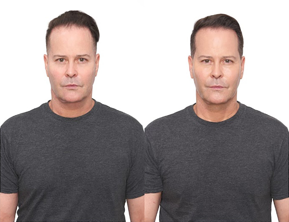 Bosley patient JD M before and after