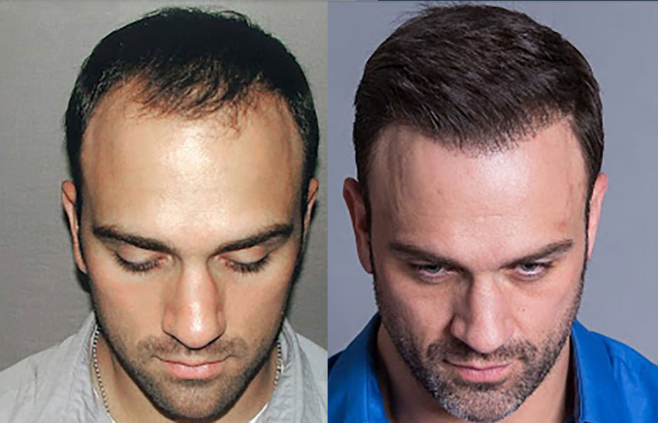 Bosley patient Jeff B before and after