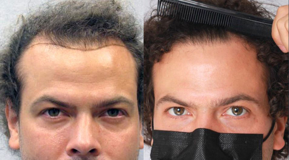 Bosley patient Jeff P. before and after