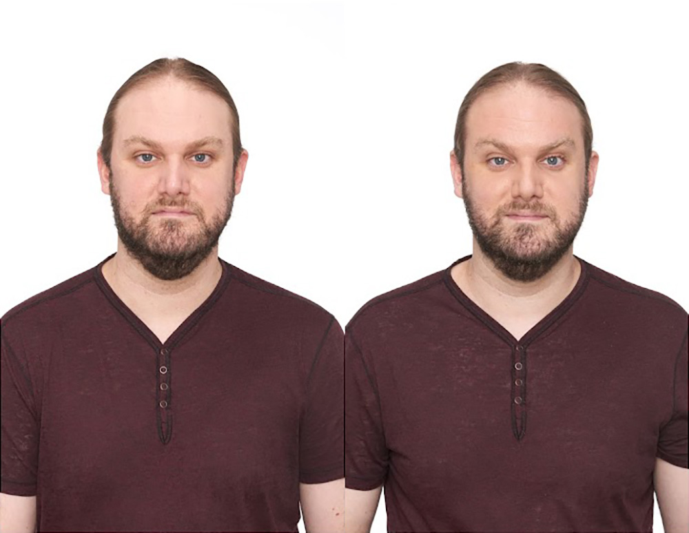 Bosley patient Jeffrey W before and after