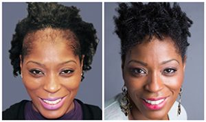 Bosley patient Jewel before and after