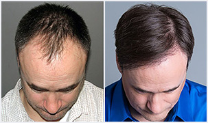 Bosley FUE patient John before and after