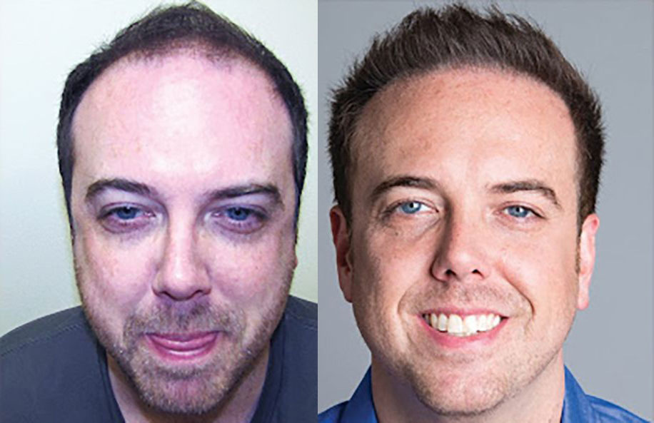 Bosley patient John H before and after
