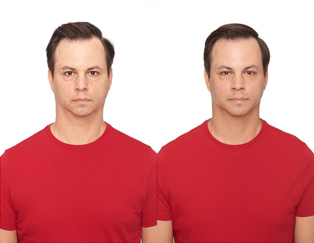 Bosley patient John S before and after