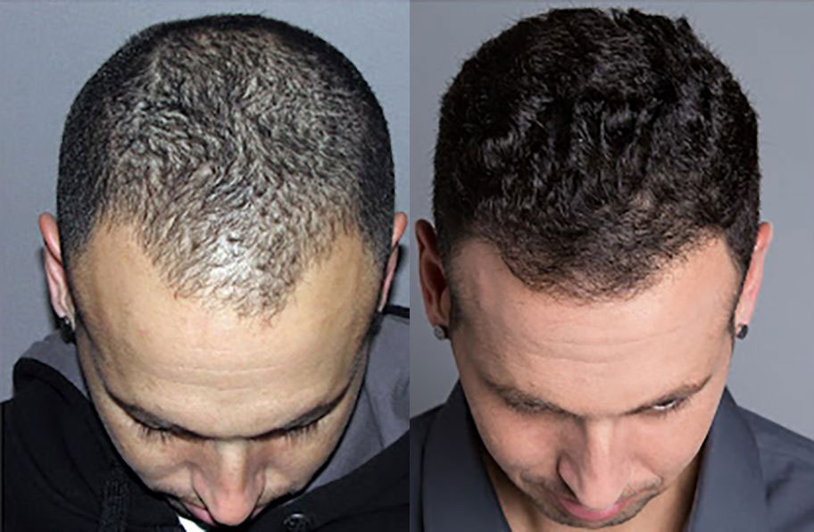 Bosley patient Jonathan J before and after