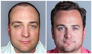 Hair Restoration and Transplants for Men and Women - Bosley Hair Transplant