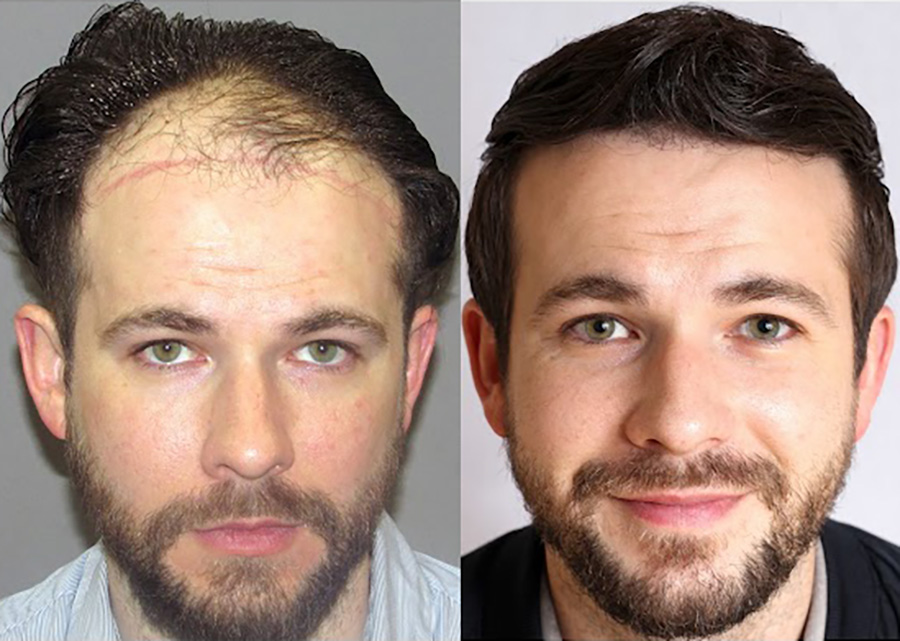 Bosley patient Josh E before and after