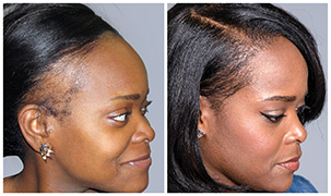 Hair Transplant Before/After Results for Women - Bosley Hair Transplant