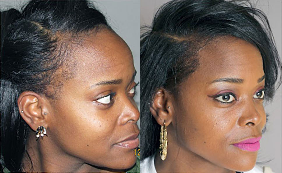 Is Bosley Hair Restoration Worth It Hair Transplant Before/After Results for Women - Bosley Hair Transplant