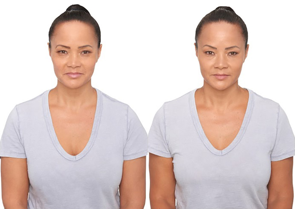 Bosley patient Kim K before and after