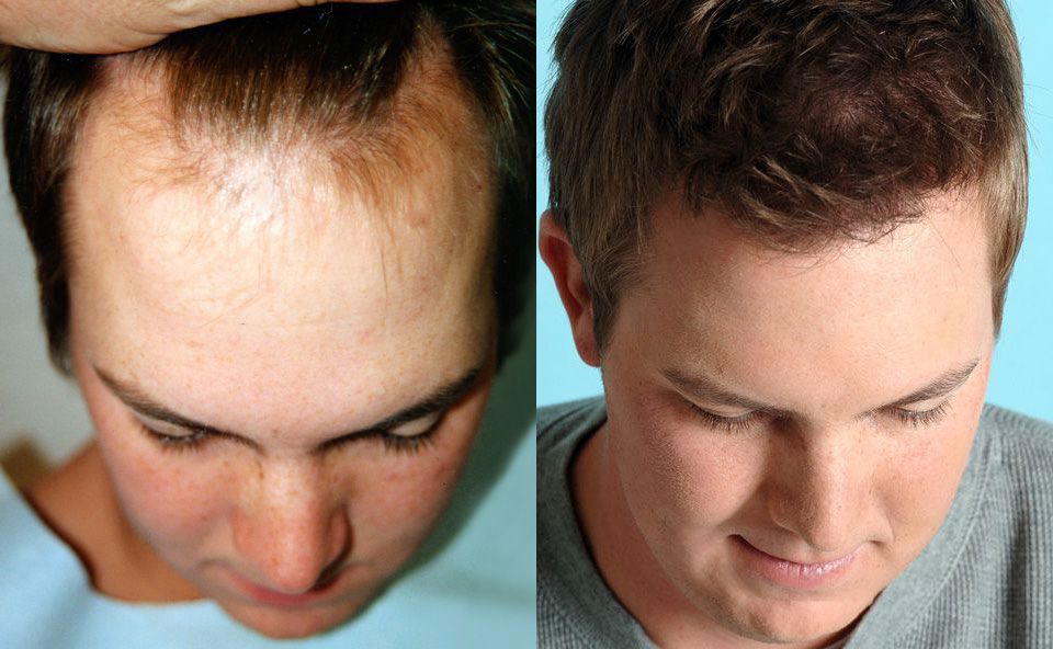 Bosley patient Kyle M. before and after