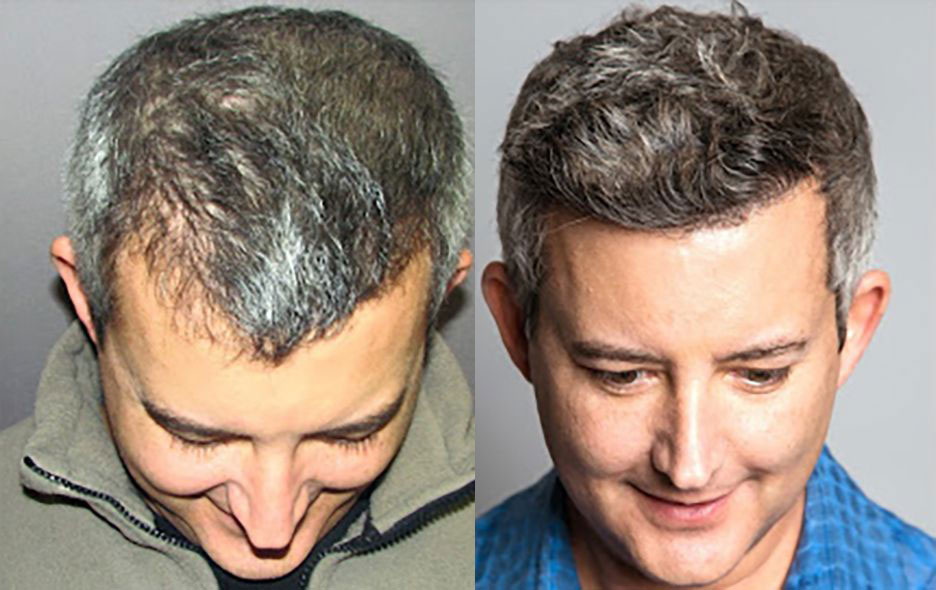 Bosley patient Mark H before and after