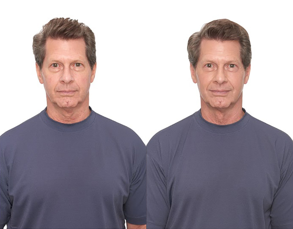 Bosley patient Mark R before and after
