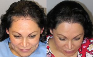 Bosley patient Martha U before and after