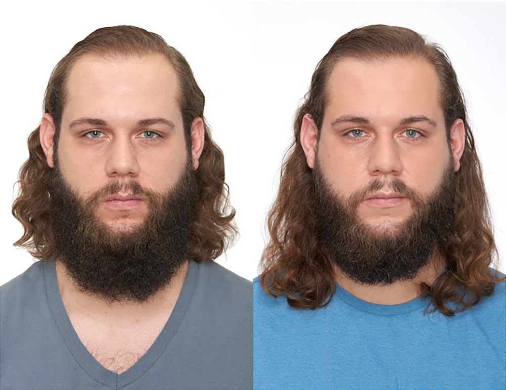 Bosley patient Matt H. before and after