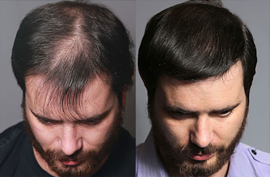 Hair Transplant Before/After Results for Men - Bosley Hair Transplant