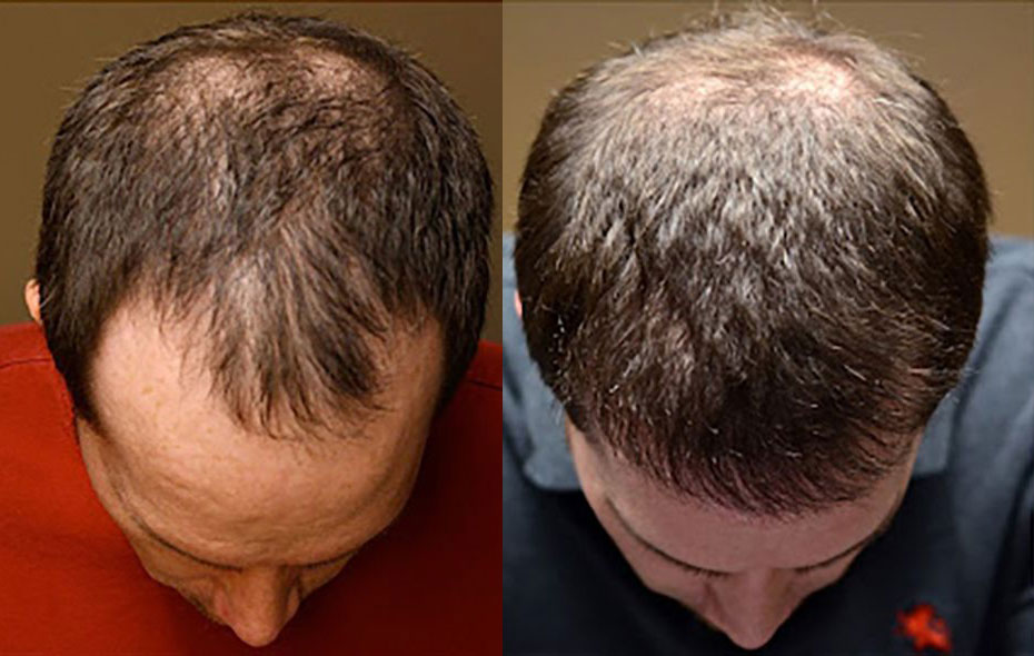 Bosley patient Michael S before and after