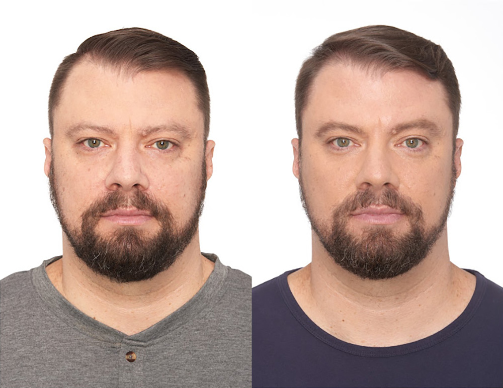 Bosley patient Mike M before and after