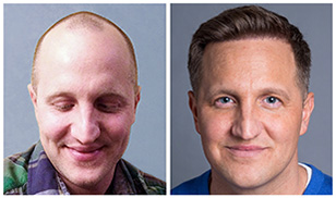 Bosley patient Nick before and after