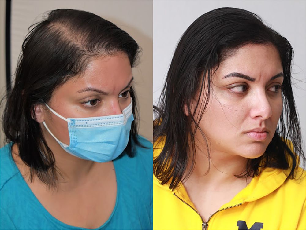 Nihara F, paciente de Bosley, antes y después