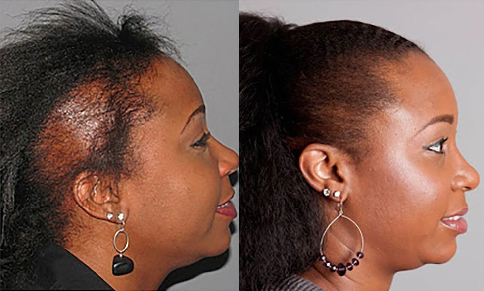 Hair Transplant Before/After Results for Women - Bosley Hair Transplant Hair Transplant Before/After Results for Women - Bosley Hair Transplant