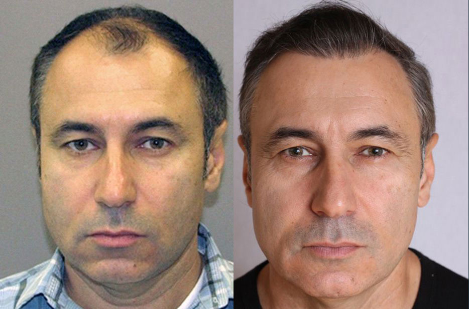 Bosley patient Oleg K. before and after