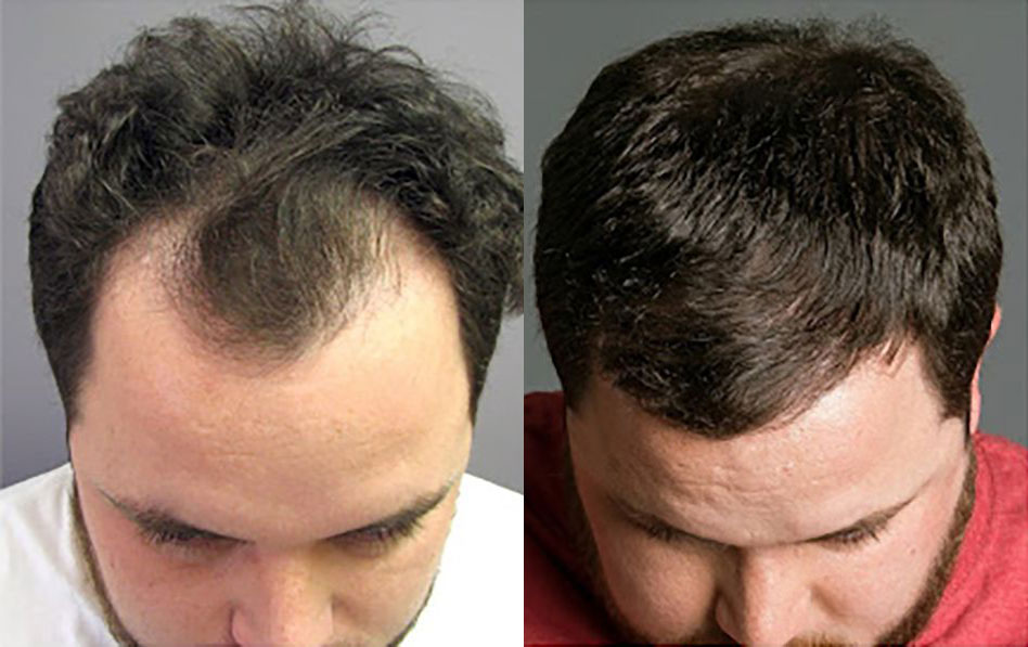 Bosley patient Patrick B before and after