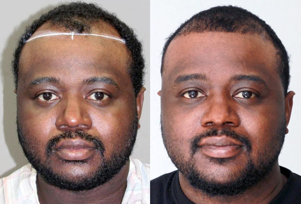 Bosley patient Perry T before and after
