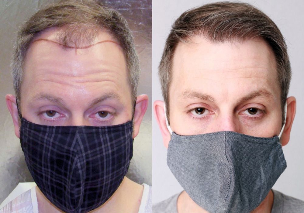 Bosley patient Pete F before and after