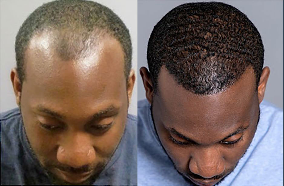 Bosley patient Raynard M. before and after