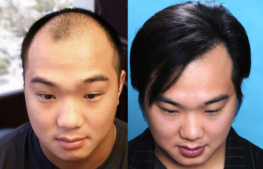 Bosley patient Roger C. before and after