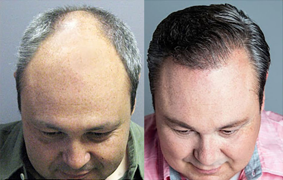 Bosley patient Rueben M before and after