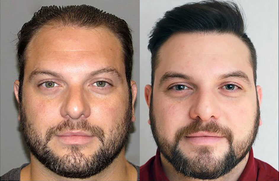 Bosley patient Ryan L. before and after