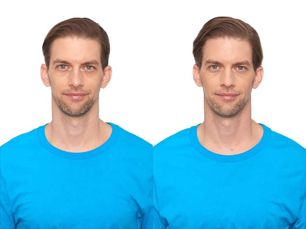 Bosley patient Sam O before and after