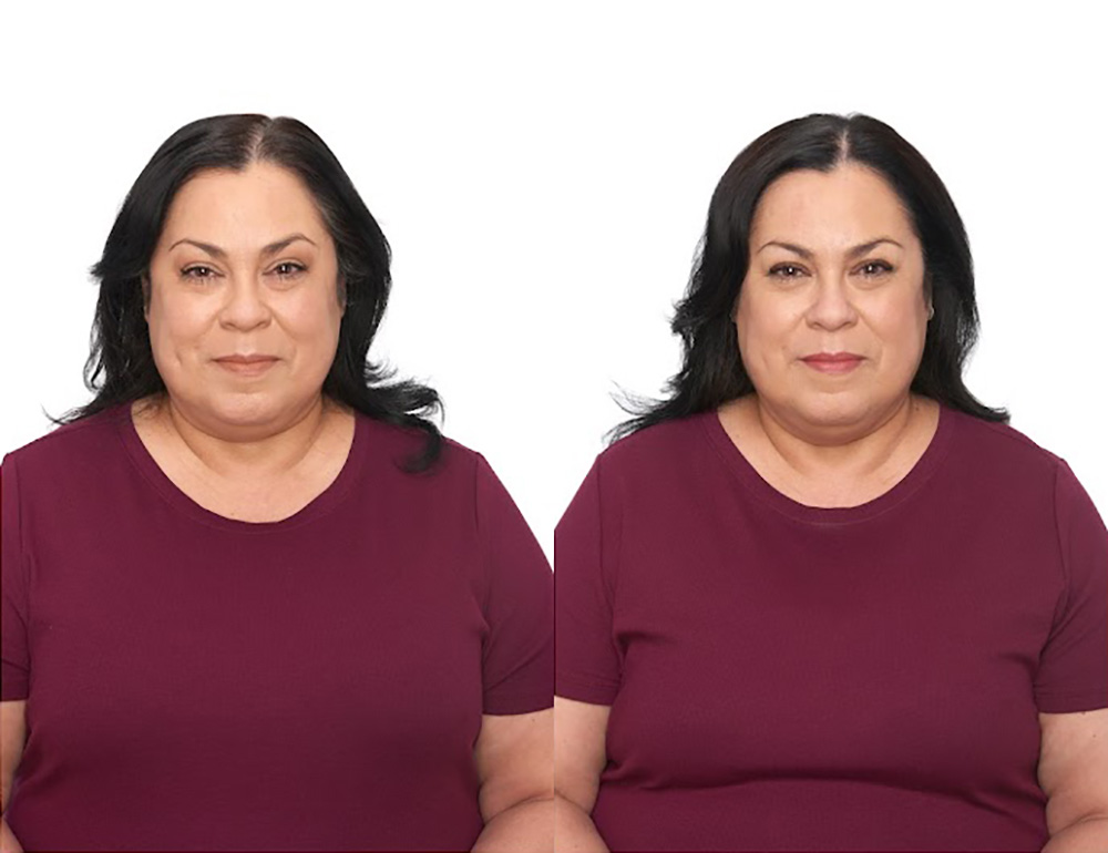 Bosley patient Sarah O before and after