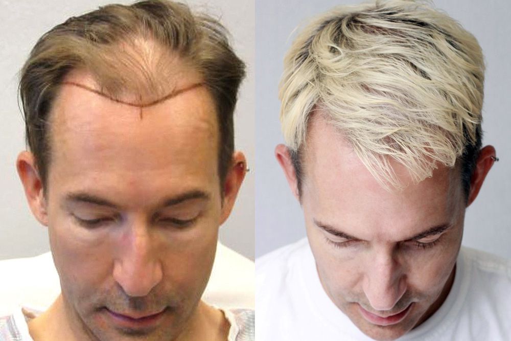 Bosley patient Stephen G before and after