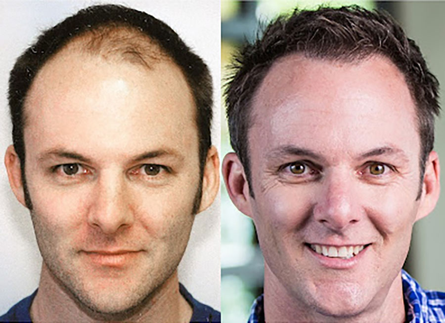 Bosley patient Steve A before and after