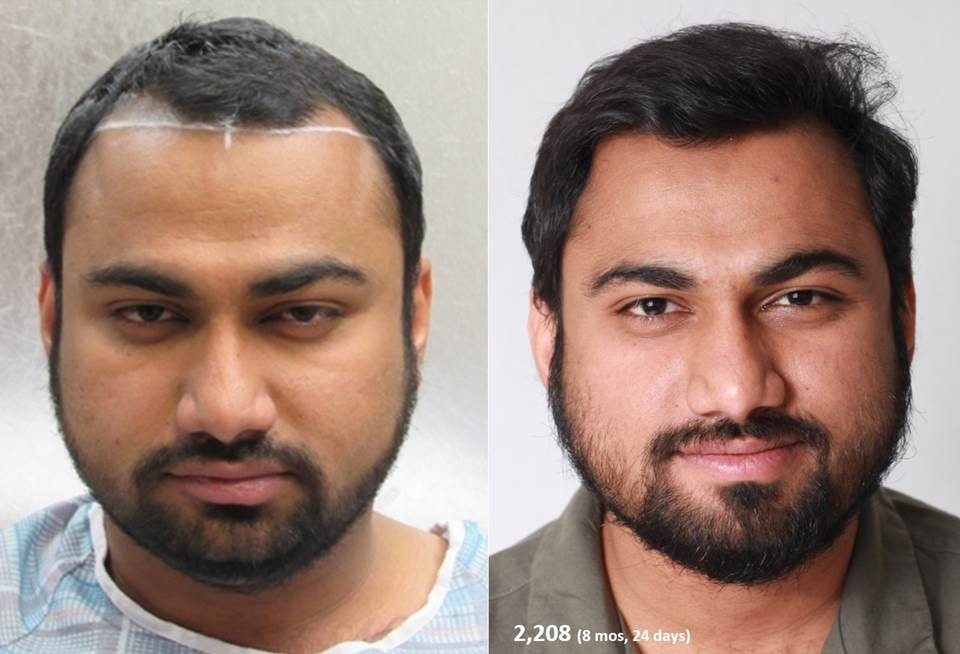 Bosley patient Sushanth V before and after