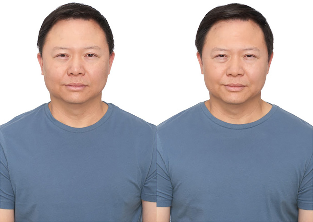 Bosley patient Tai L before and after