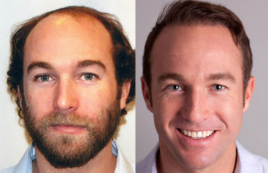 Bosley patient Torrance J. before and after