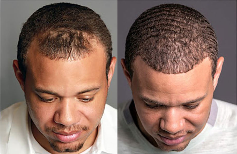 FUE Transplant Before & After