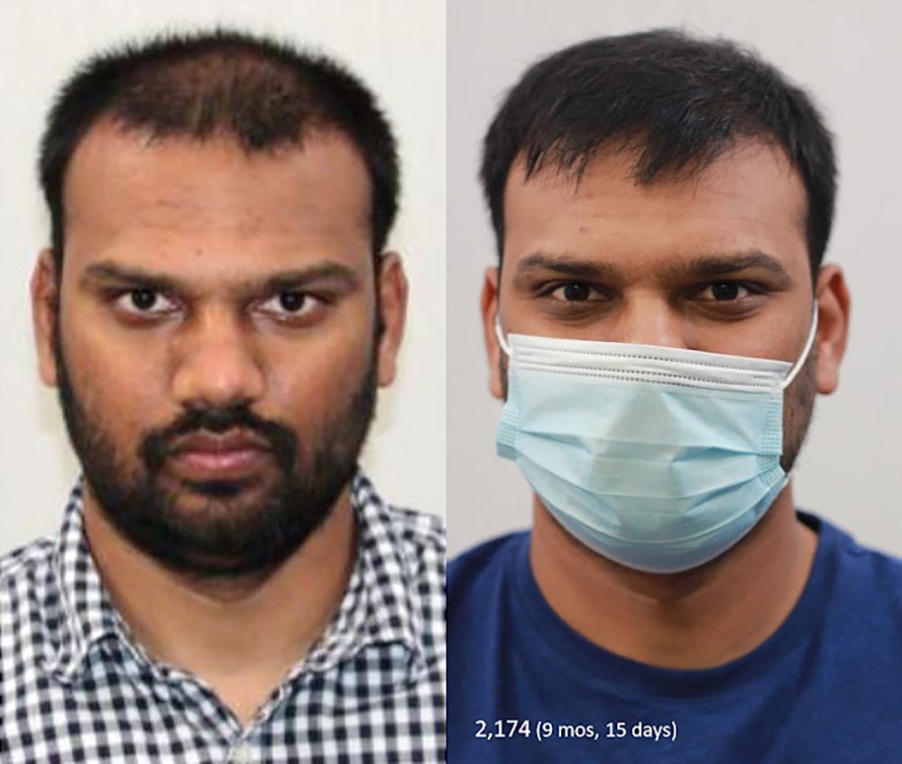 Bosley patient Veereswara before and after