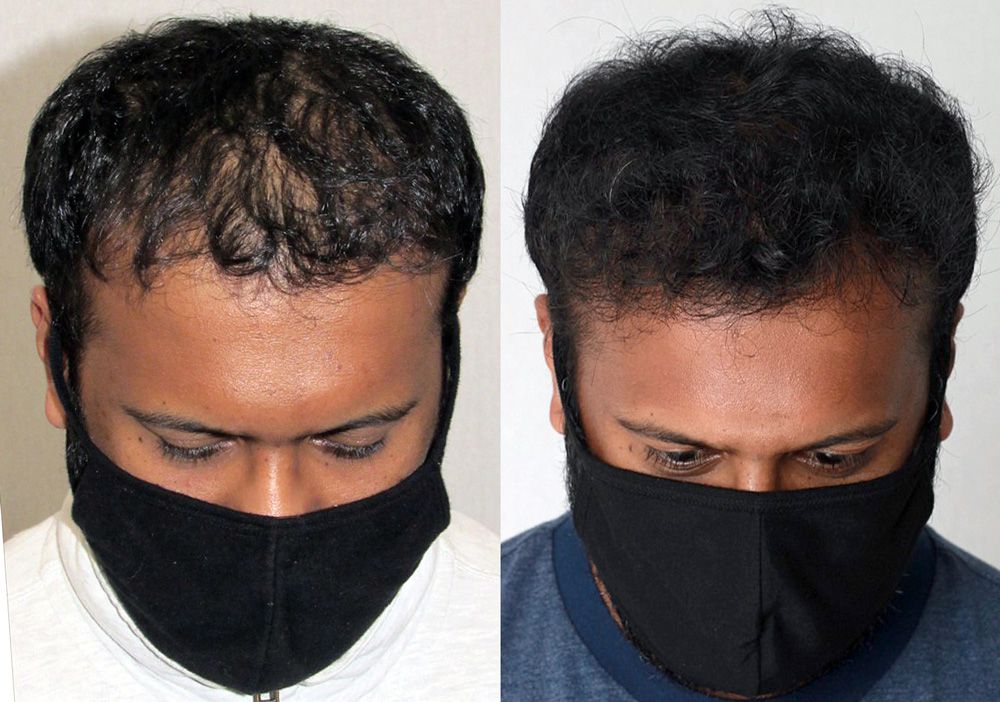 Bosley patient Vijay K before and after